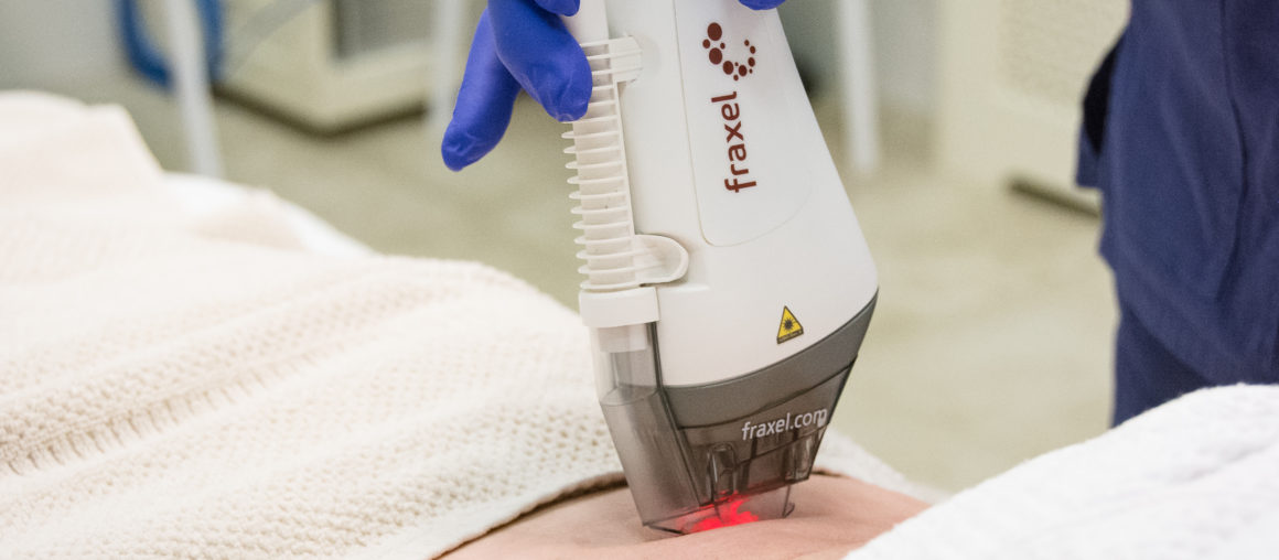 Эффективное и безболезненное лечение растяжек с помощью лазерного аппарата Fraxel