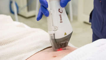 Эффективное и безболезненное лечение растяжек с помощью лазерного аппарата Fraxel