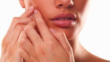 Очистка кожи при возрастном акне у женщин