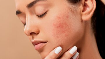Как не допустить формирования шрамов при ранах на коже?